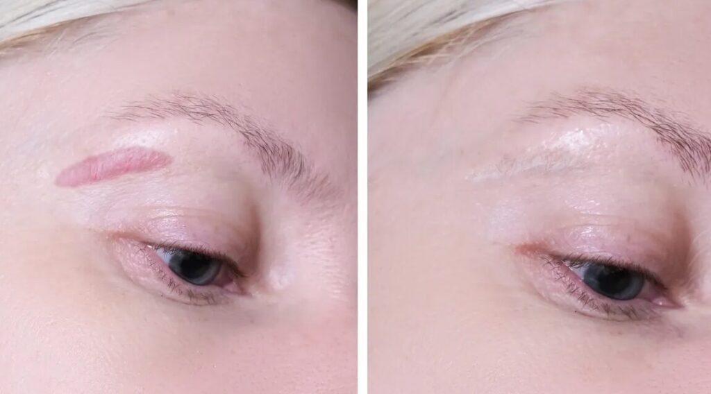 aser scar removal ukraine